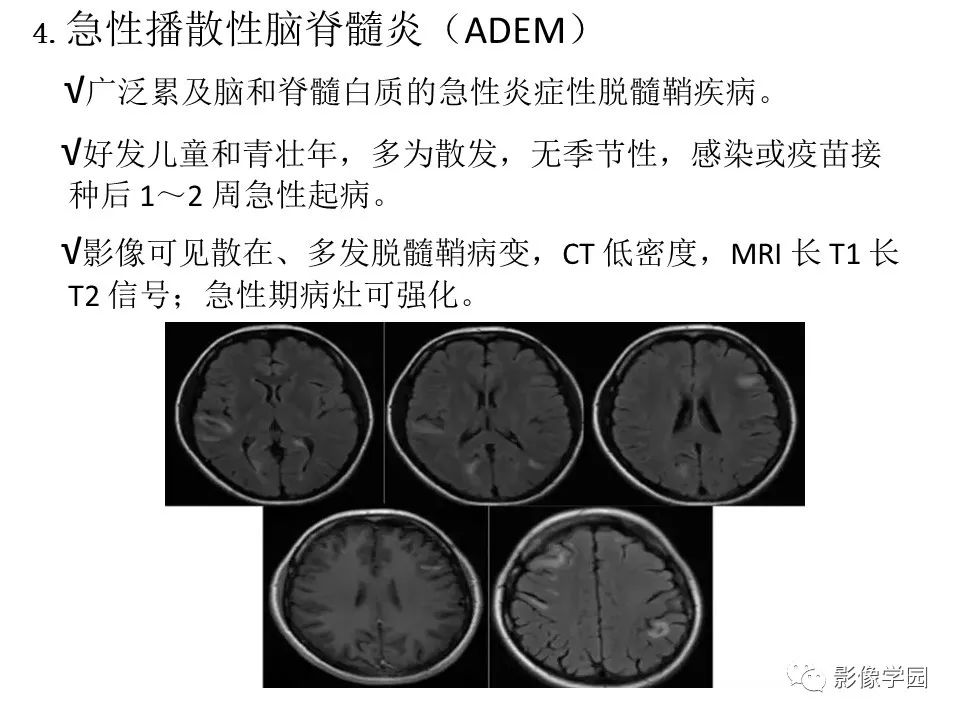可逆性后部脑病综合征 PRES 可逆性后部脑病综合征 PRES