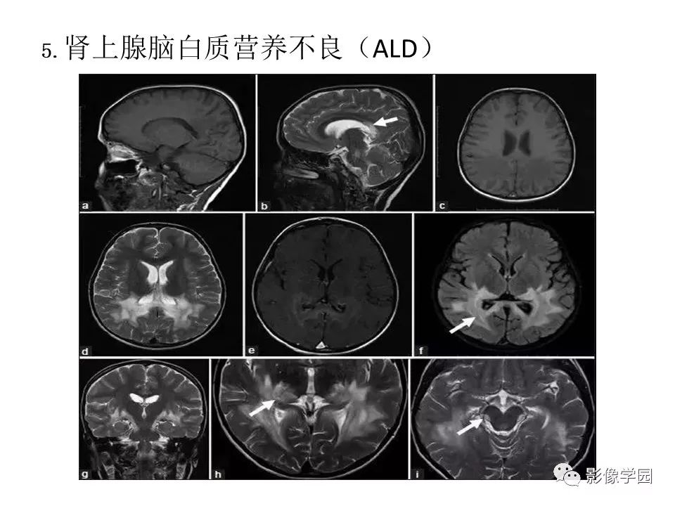 可逆性后部脑病综合征 PRES 可逆性后部脑病综合征 PRES