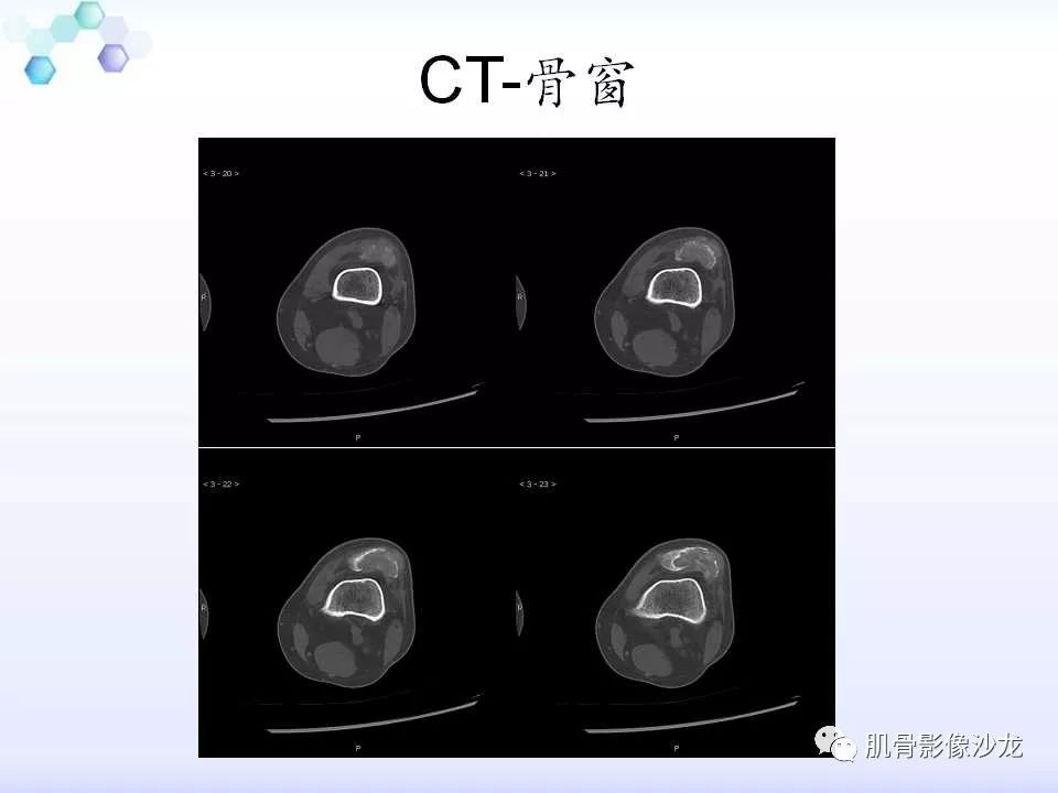 【病例】膝关节痛风性关节炎1例CT 【病例】膝关节痛风性关节炎1例CT