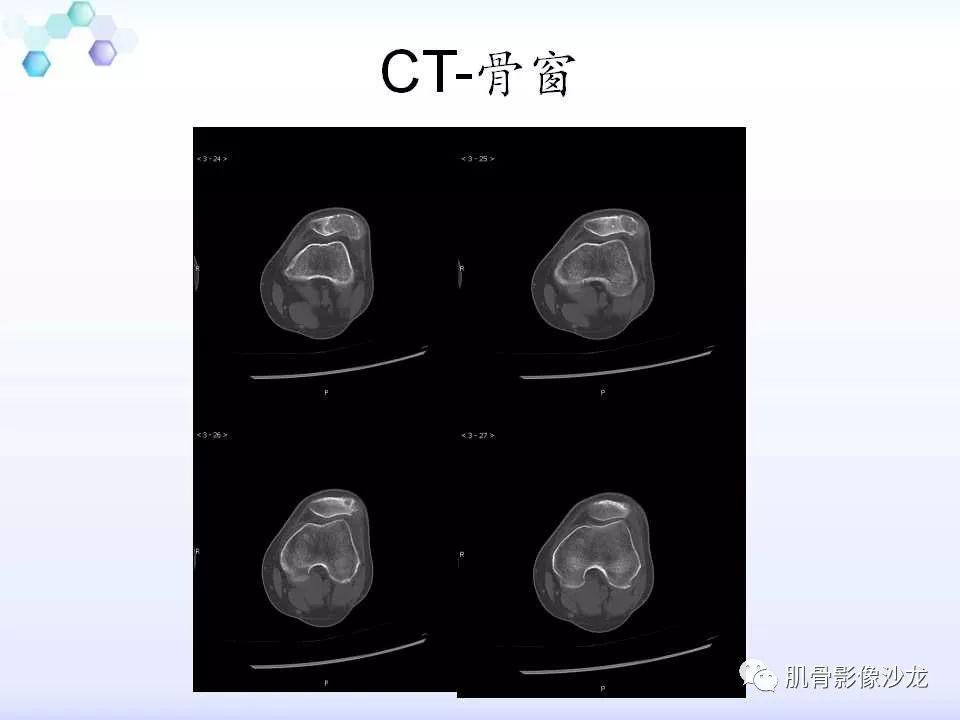 【病例】膝关节痛风性关节炎1例CT 【病例】膝关节痛风性关节炎1例CT