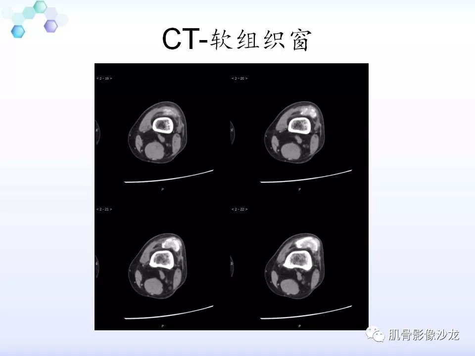 【病例】膝关节痛风性关节炎1例CT 【病例】膝关节痛风性关节炎1例CT