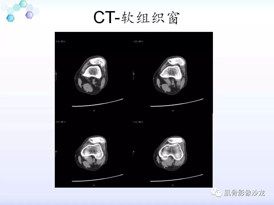 【病例】膝关节痛风性关节炎1例CT 【病例】膝关节痛风性关节炎1例CT