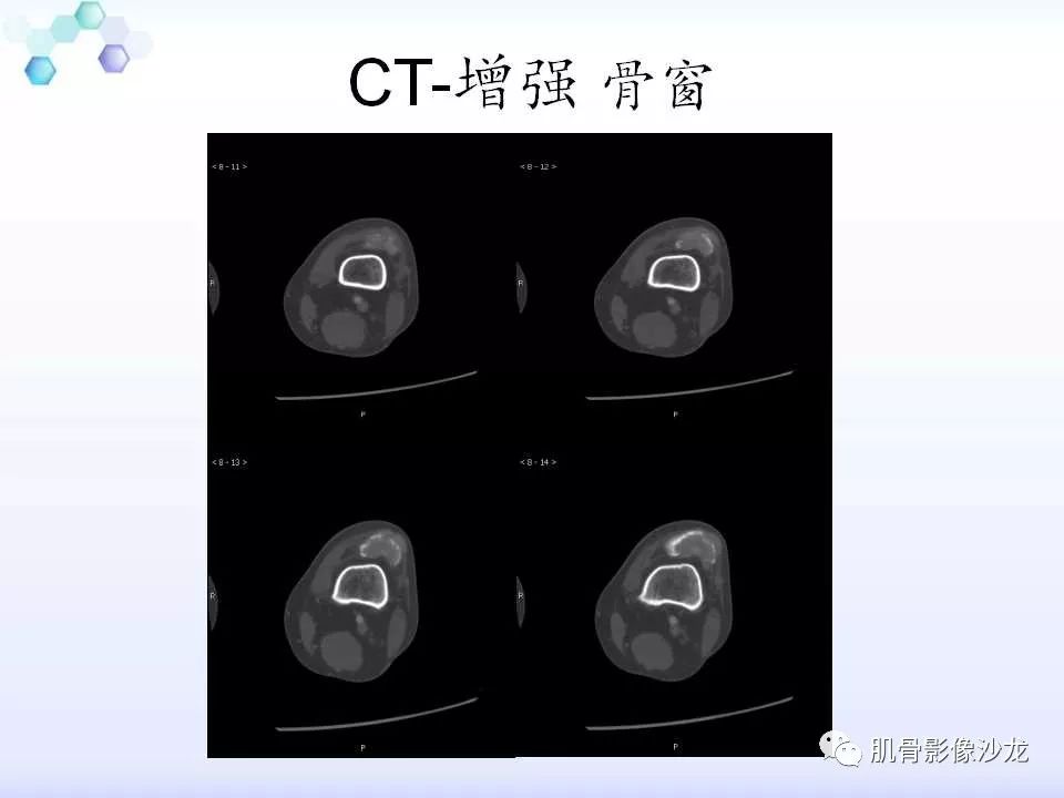 【病例】膝关节痛风性关节炎1例CT 【病例】膝关节痛风性关节炎1例CT