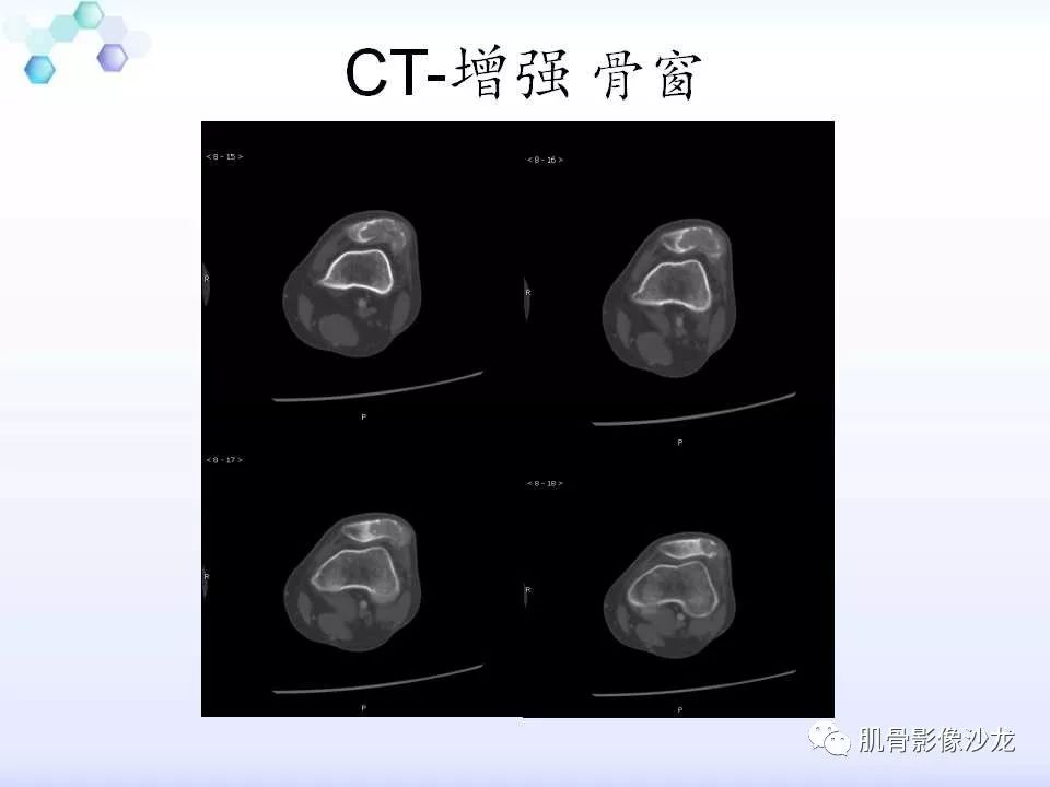 【病例】膝关节痛风性关节炎1例CT 【病例】膝关节痛风性关节炎1例CT