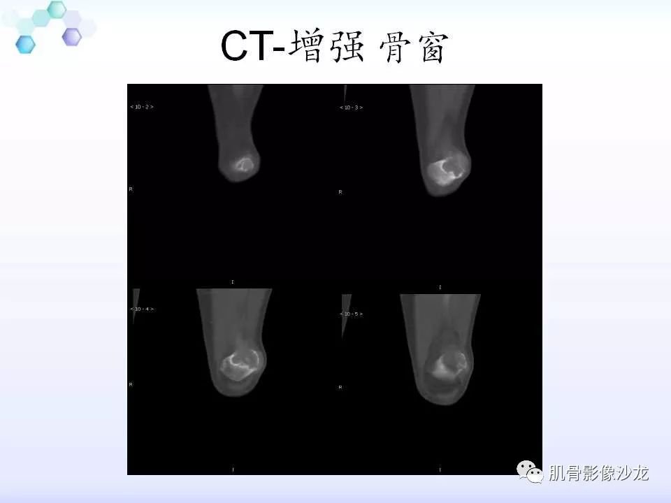 【病例】膝关节痛风性关节炎1例CT 【病例】膝关节痛风性关节炎1例CT