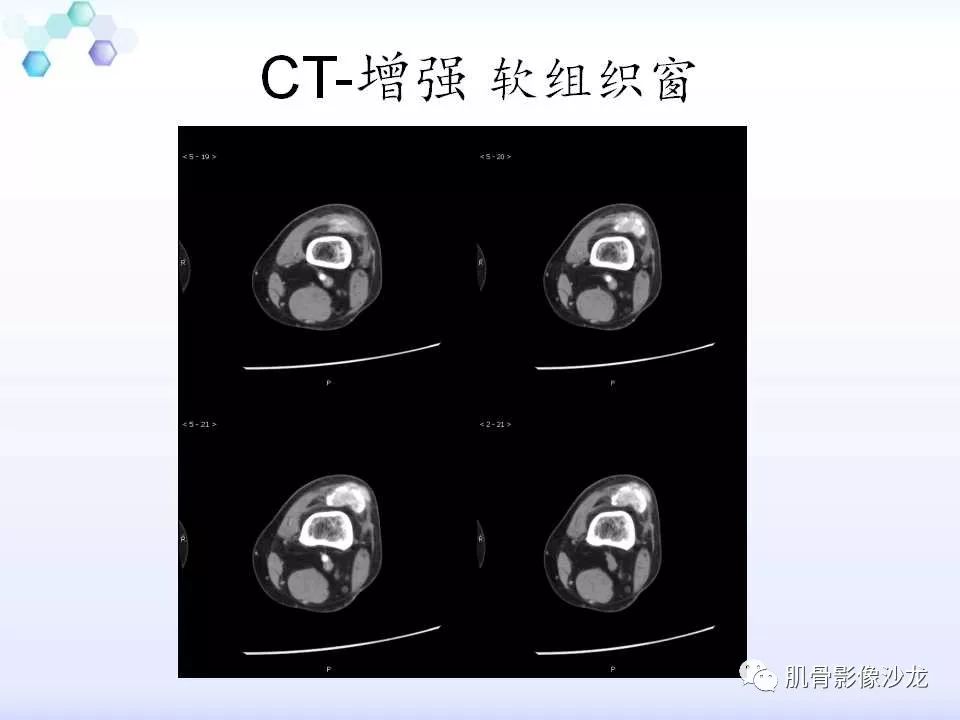 【病例】膝关节痛风性关节炎1例CT 【病例】膝关节痛风性关节炎1例CT