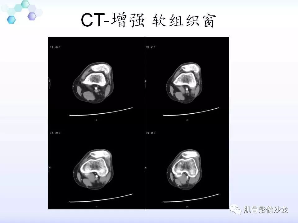 【病例】膝关节痛风性关节炎1例CT 【病例】膝关节痛风性关节炎1例CT