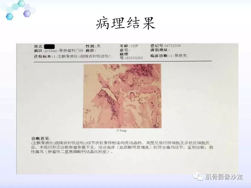【病例】膝关节痛风性关节炎1例CT 【病例】膝关节痛风性关节炎1例CT