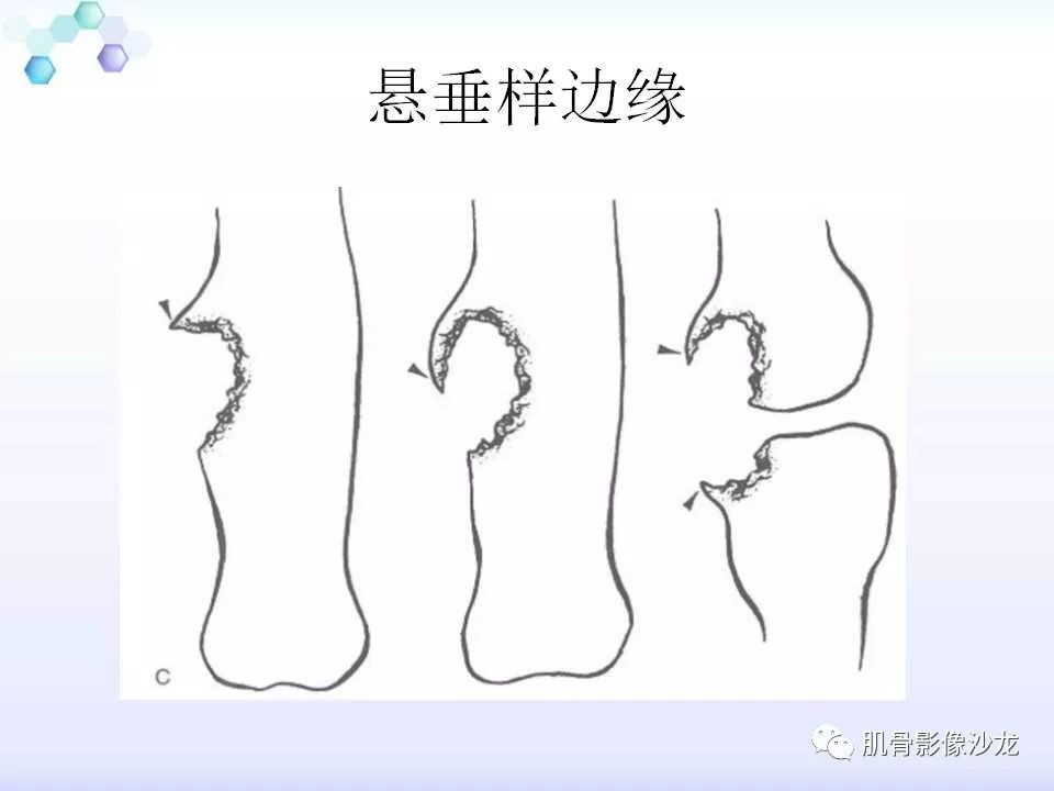 【病例】膝关节痛风性关节炎1例CT 【病例】膝关节痛风性关节炎1例CT