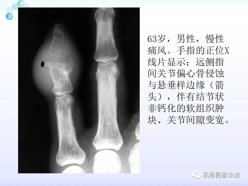 【病例】膝关节痛风性关节炎1例CT 【病例】膝关节痛风性关节炎1例CT