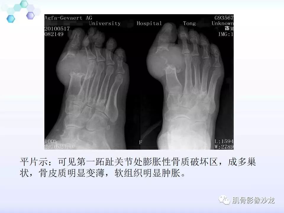 【病例】膝关节痛风性关节炎1例CT 【病例】膝关节痛风性关节炎1例CT