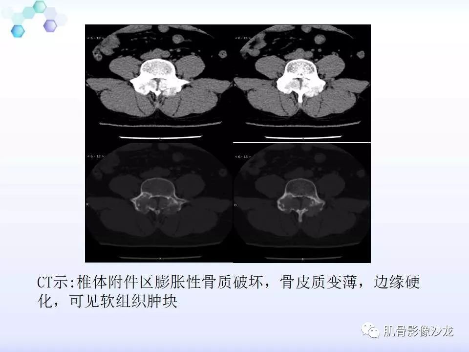 【病例】膝关节痛风性关节炎1例CT 【病例】膝关节痛风性关节炎1例CT