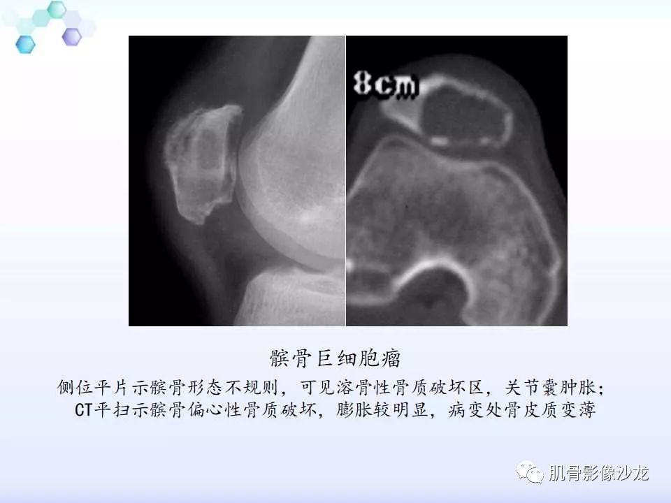 【病例】膝关节痛风性关节炎1例CT 【病例】膝关节痛风性关节炎1例CT