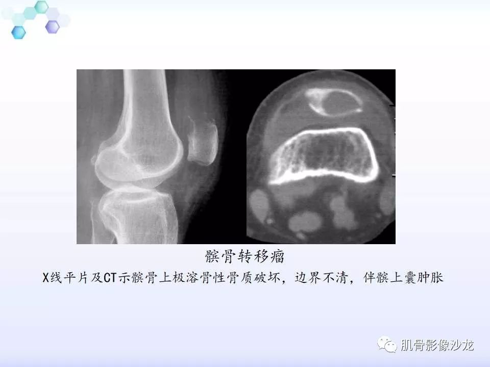 【病例】膝关节痛风性关节炎1例CT 【病例】膝关节痛风性关节炎1例CT