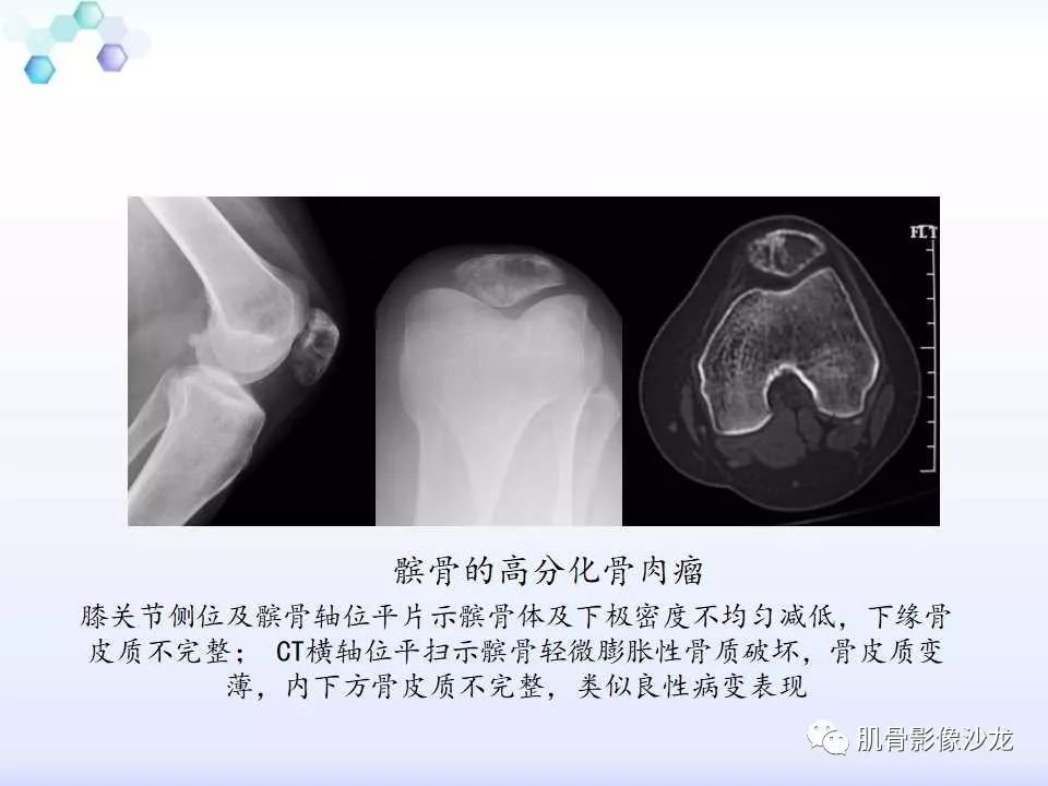 【病例】膝关节痛风性关节炎1例CT 【病例】膝关节痛风性关节炎1例CT