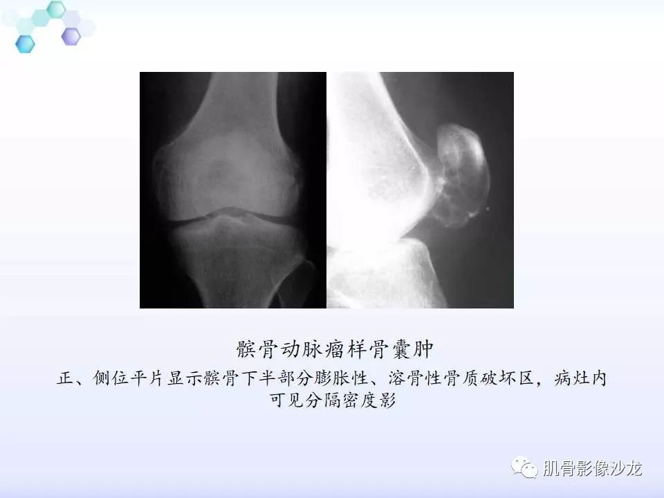 【病例】膝关节痛风性关节炎1例CT 【病例】膝关节痛风性关节炎1例CT