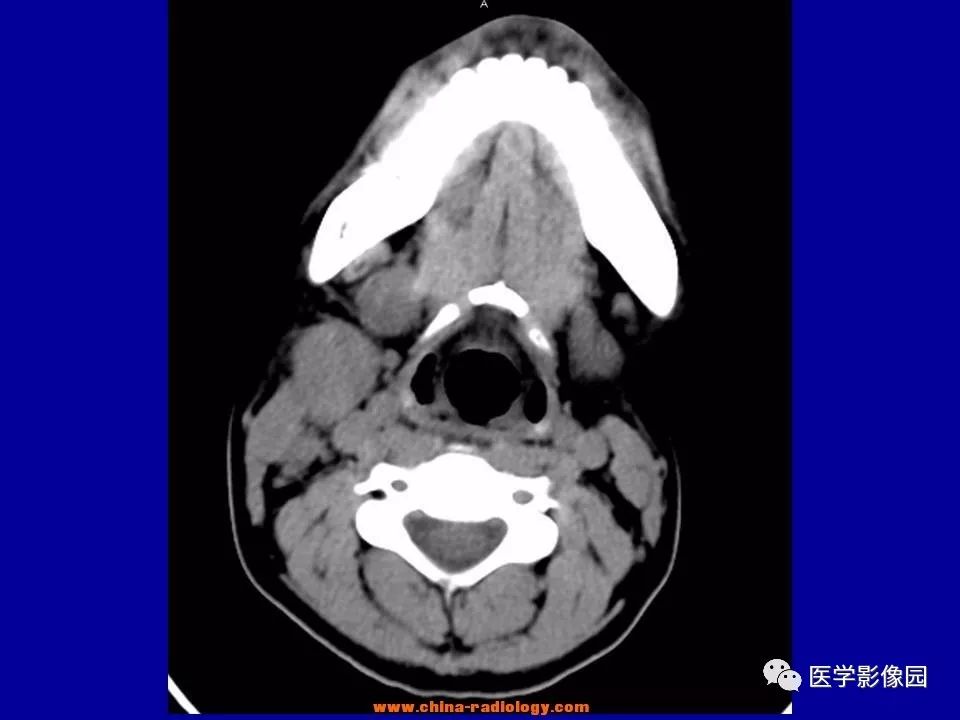 【病例】颈部淋巴结炎1例CT 【病例】颈部淋巴结炎1例CT