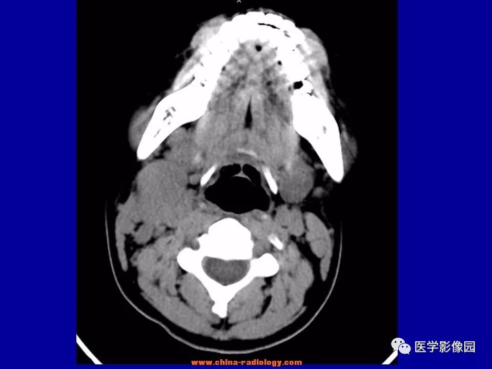 【病例】颈部淋巴结炎1例CT 【病例】颈部淋巴结炎1例CT