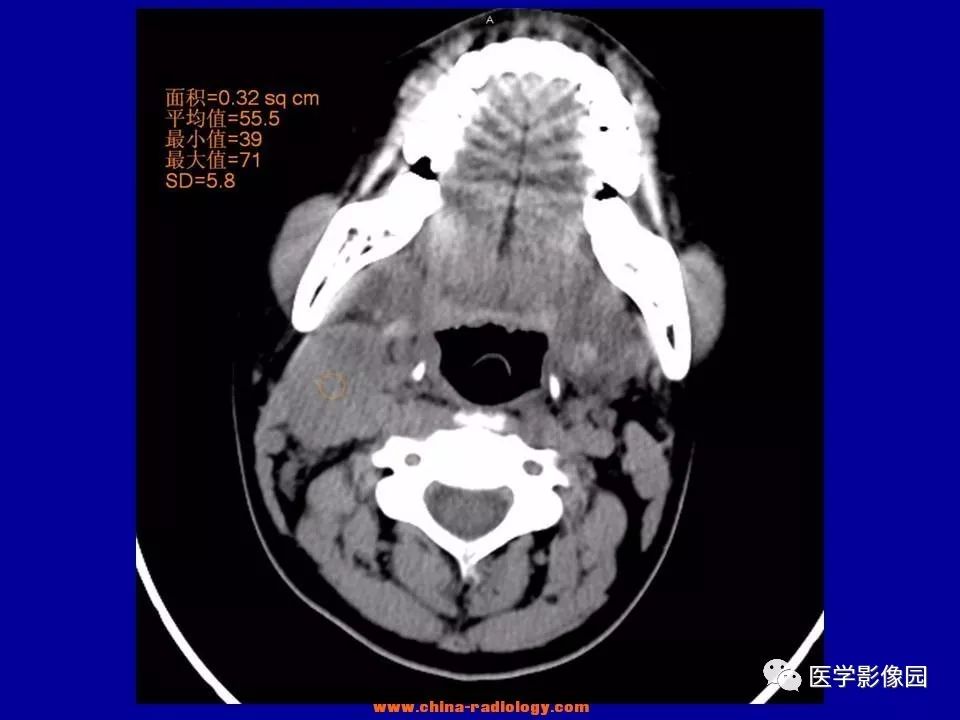 【病例】颈部淋巴结炎1例CT 【病例】颈部淋巴结炎1例CT