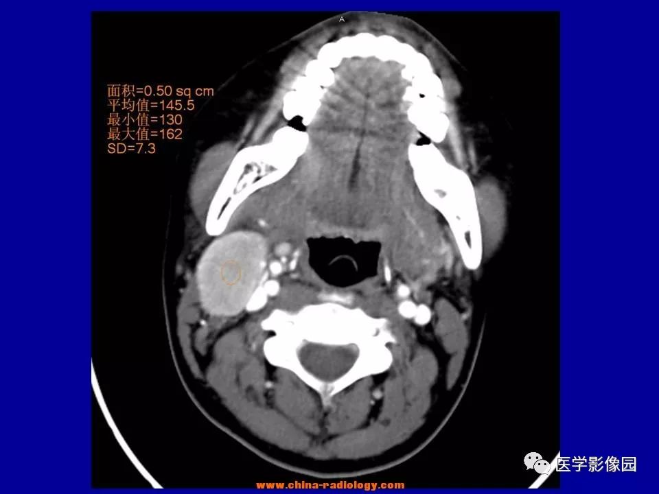 【病例】颈部淋巴结炎1例CT 【病例】颈部淋巴结炎1例CT