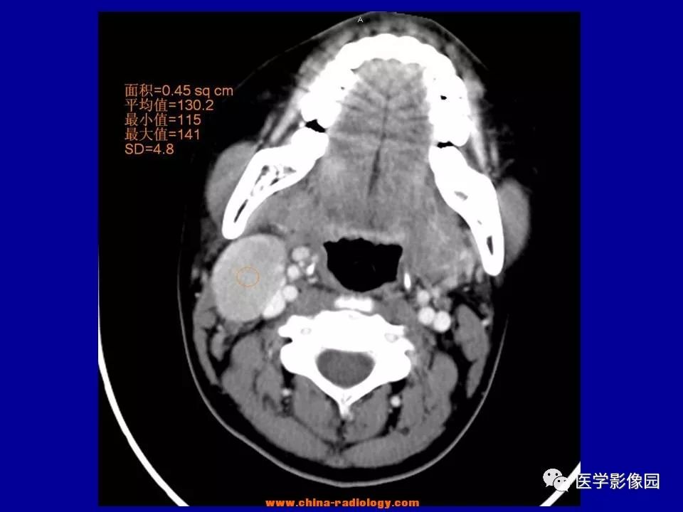 【病例】颈部淋巴结炎1例CT 【病例】颈部淋巴结炎1例CT