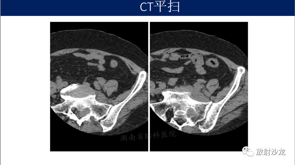 【病例】腹盆腔淋巴瘤1例CT影像表现