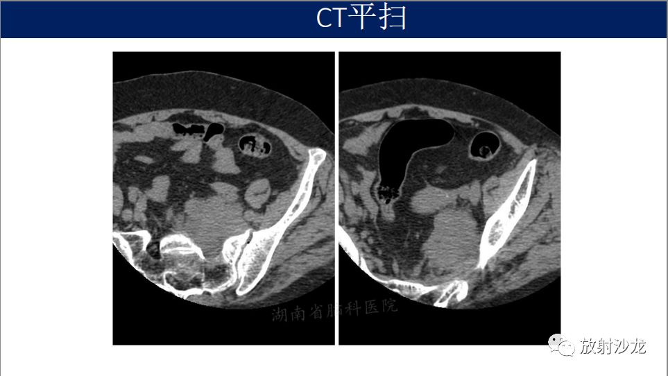 【病例】腹盆腔淋巴瘤1例CT影像表现