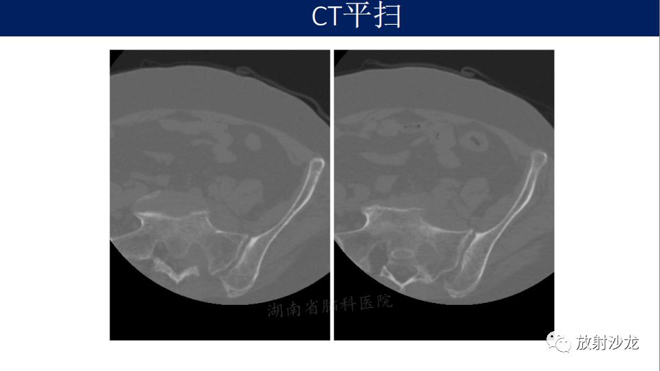 【病例】腹盆腔淋巴瘤1例CT影像表现