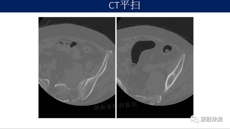 【病例】腹盆腔淋巴瘤1例CT影像表现