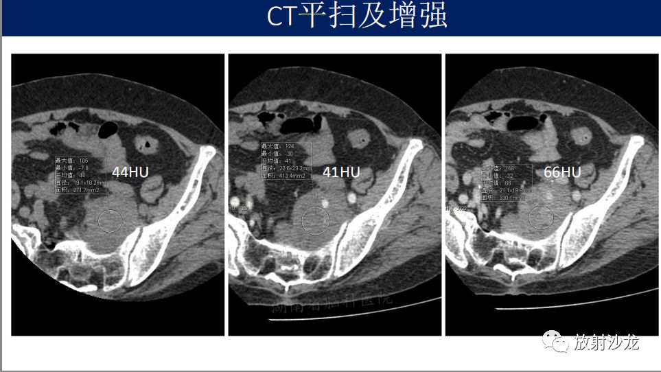 【病例】腹盆腔淋巴瘤1例CT影像表现