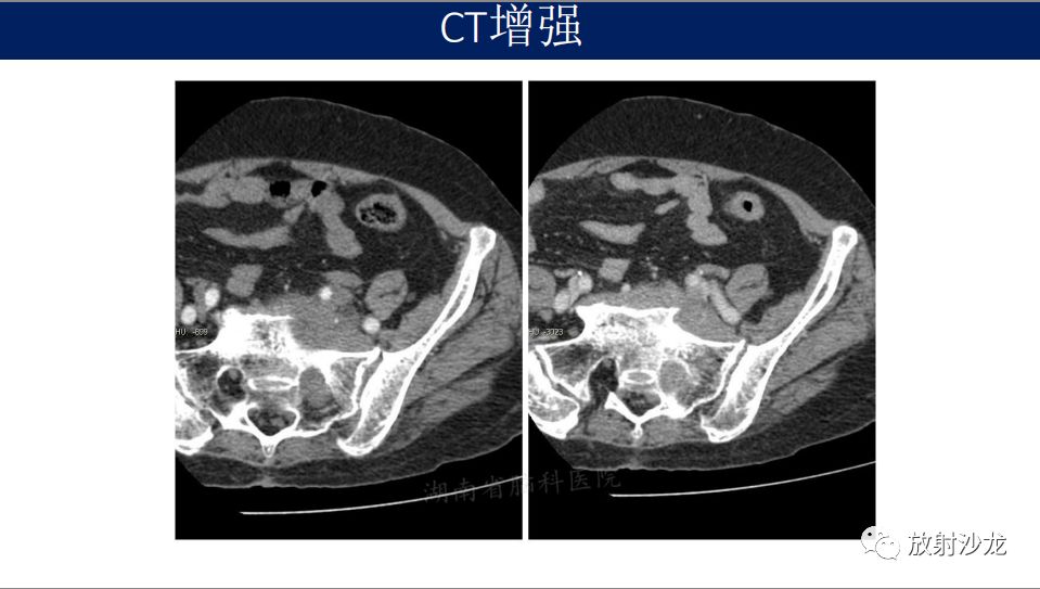 【病例】腹盆腔淋巴瘤1例CT影像表现