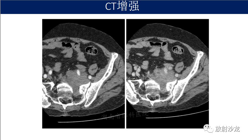 【病例】腹盆腔淋巴瘤1例CT影像表现