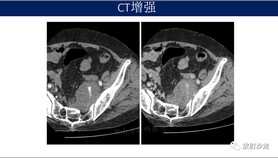 【病例】腹盆腔淋巴瘤1例CT影像表现