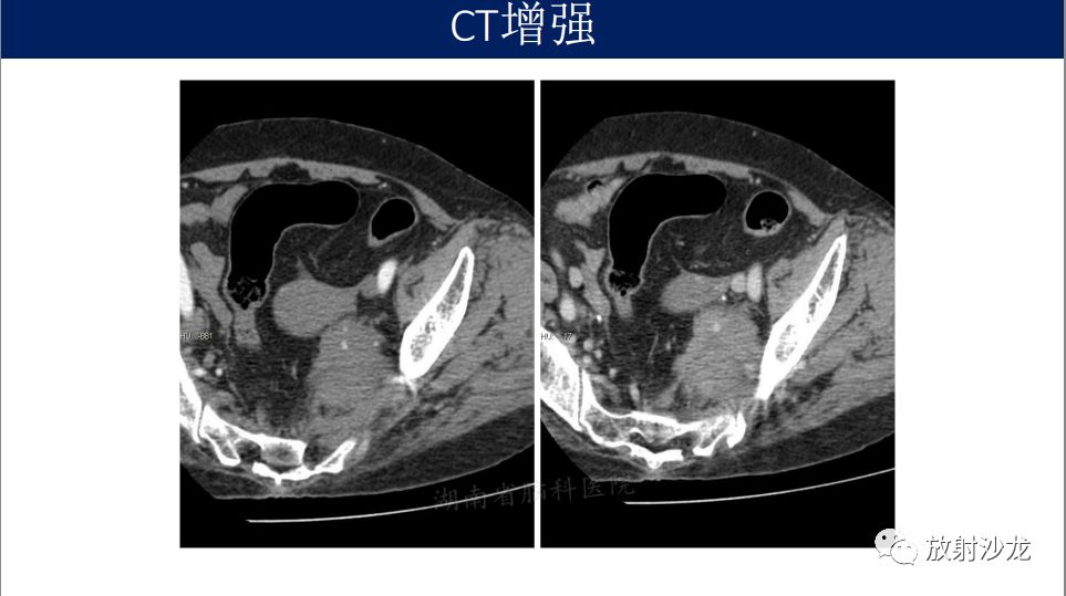 【病例】腹盆腔淋巴瘤1例CT影像表现