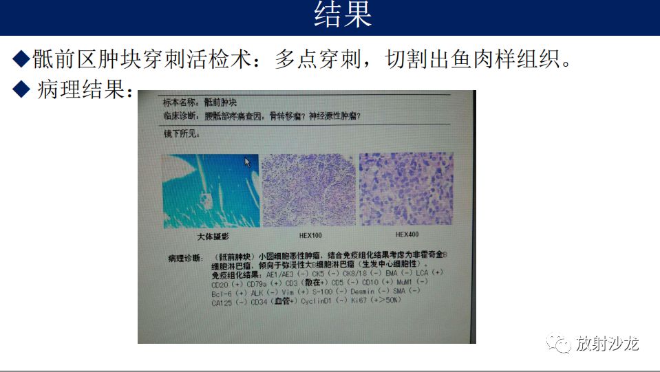 【病例】腹盆腔淋巴瘤1例CT影像表现