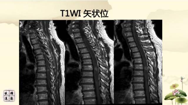 【病例】脊髓血管母细胞瘤1例MR影像诊断分析
