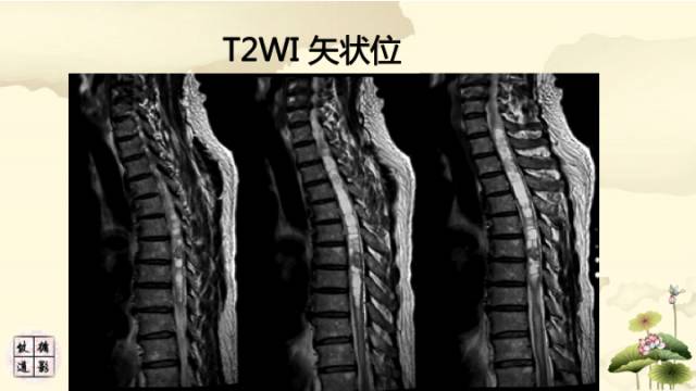 【病例】脊髓血管母细胞瘤1例MR影像诊断分析
