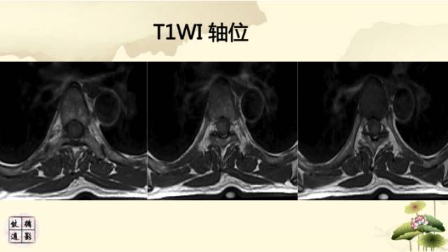 【病例】脊髓血管母细胞瘤1例MR影像诊断分析