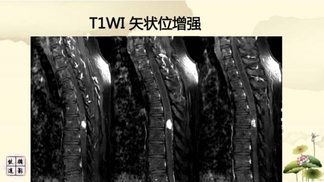 【病例】脊髓血管母细胞瘤1例MR影像诊断分析
