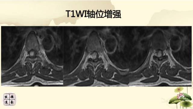 【病例】脊髓血管母细胞瘤1例MR影像诊断分析