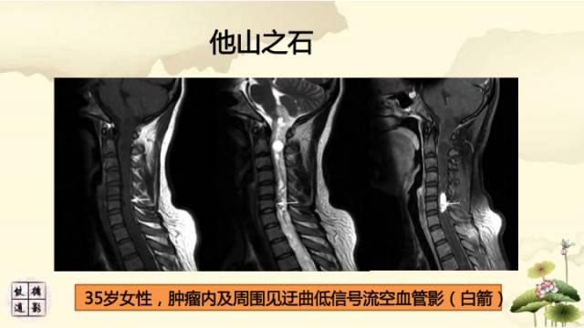 【病例】脊髓血管母细胞瘤1例MR影像诊断分析