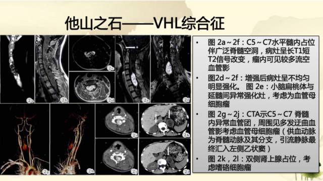 【病例】脊髓血管母细胞瘤1例MR影像诊断分析