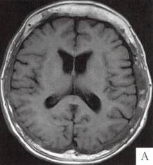 【病例】颅骨畸形性骨炎1例CT 【病例】颅骨畸形性骨炎1例CT