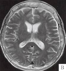 【病例】颅骨畸形性骨炎1例CT 【病例】颅骨畸形性骨炎1例CT