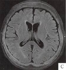 【病例】颅骨畸形性骨炎1例CT 【病例】颅骨畸形性骨炎1例CT