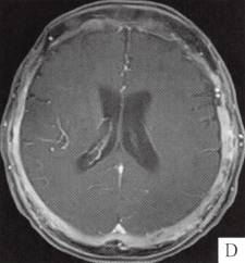 【病例】颅骨畸形性骨炎1例CT 【病例】颅骨畸形性骨炎1例CT