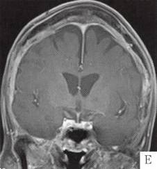 【病例】颅骨畸形性骨炎1例CT 【病例】颅骨畸形性骨炎1例CT