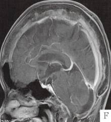 【病例】颅骨畸形性骨炎1例CT 【病例】颅骨畸形性骨炎1例CT