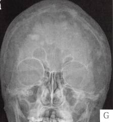 【病例】颅骨畸形性骨炎1例CT