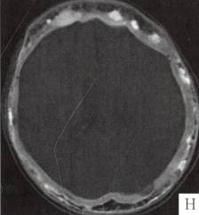 【病例】颅骨畸形性骨炎1例CT 【病例】颅骨畸形性骨炎1例CT